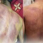 Nasruddin menunjukkan kondisi anaknya yang mengalami luka memar usai diduga dianiaya dua oknum TNI di kawasan Alue Peunyareng, Aceh Barat.(20/2/2026)