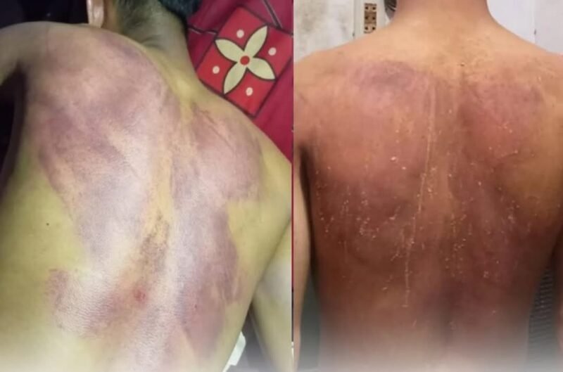 Nasruddin menunjukkan kondisi anaknya yang mengalami luka memar usai diduga dianiaya dua oknum TNI di kawasan Alue Peunyareng, Aceh Barat.(20/2/2026)